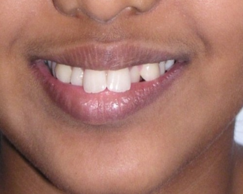 invisible ba case 11