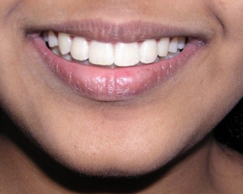 invisible ba case 11_2