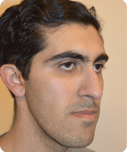 invisible ba case 12.2