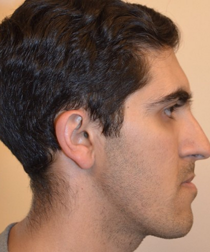 invisible ba case 12.2_3