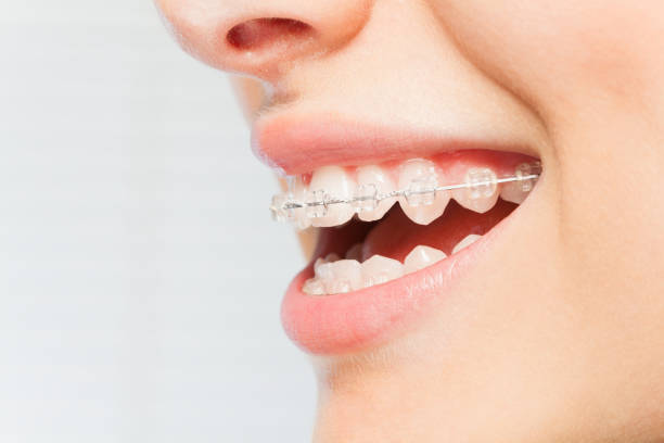 Ceramic Braces Procedure