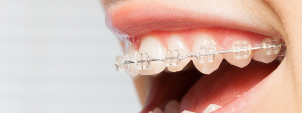 Self Ligating Braces in Mumbai