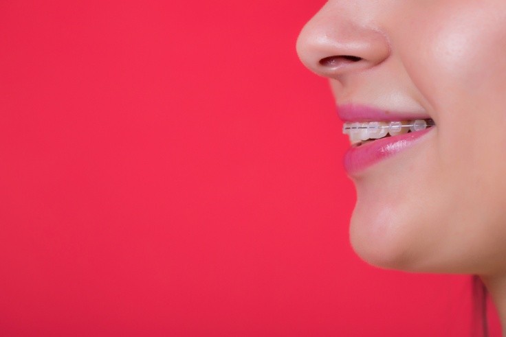 Benefits of Self Ligating Braces
