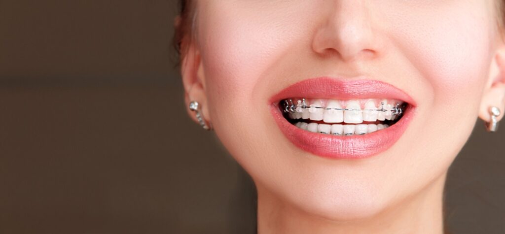 Cost of Self Ligating Braces in mumbai