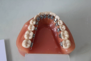 Science Behind Lingual Braces