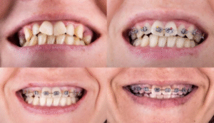 How Long Do Metal Braces Take?