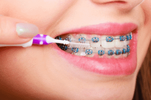 Caring for Your Braces