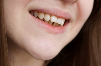 Who is Invisalign and SmileAligners Suitable For?