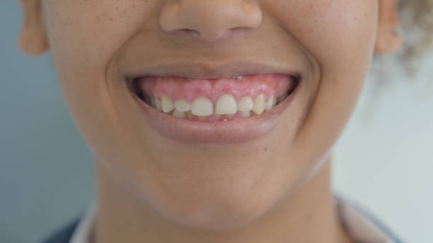 Who Needs Smile Designing?