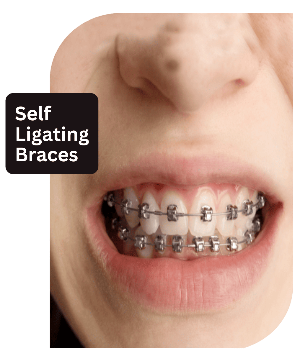 self ligating braces