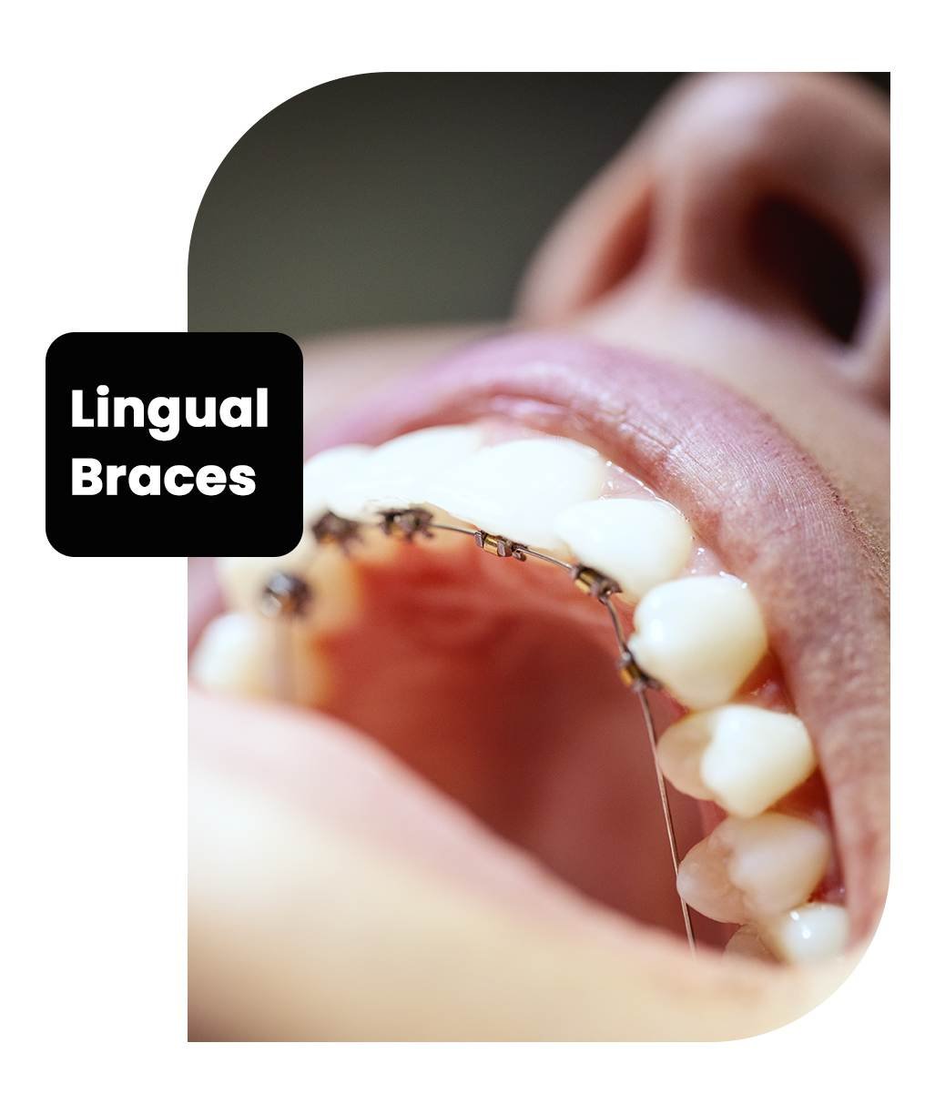 ligual-braces