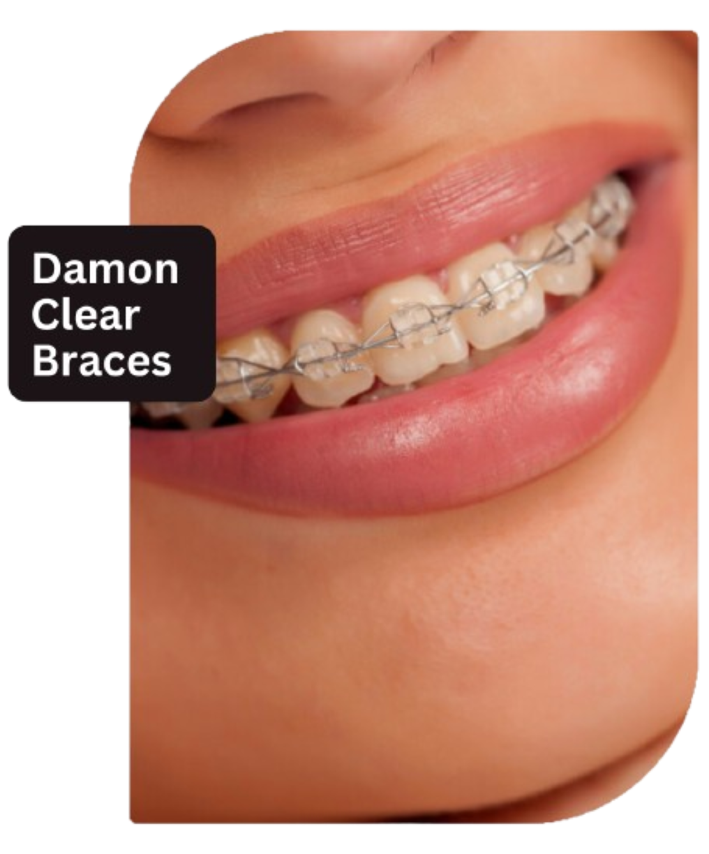 Damon Clear Braces image