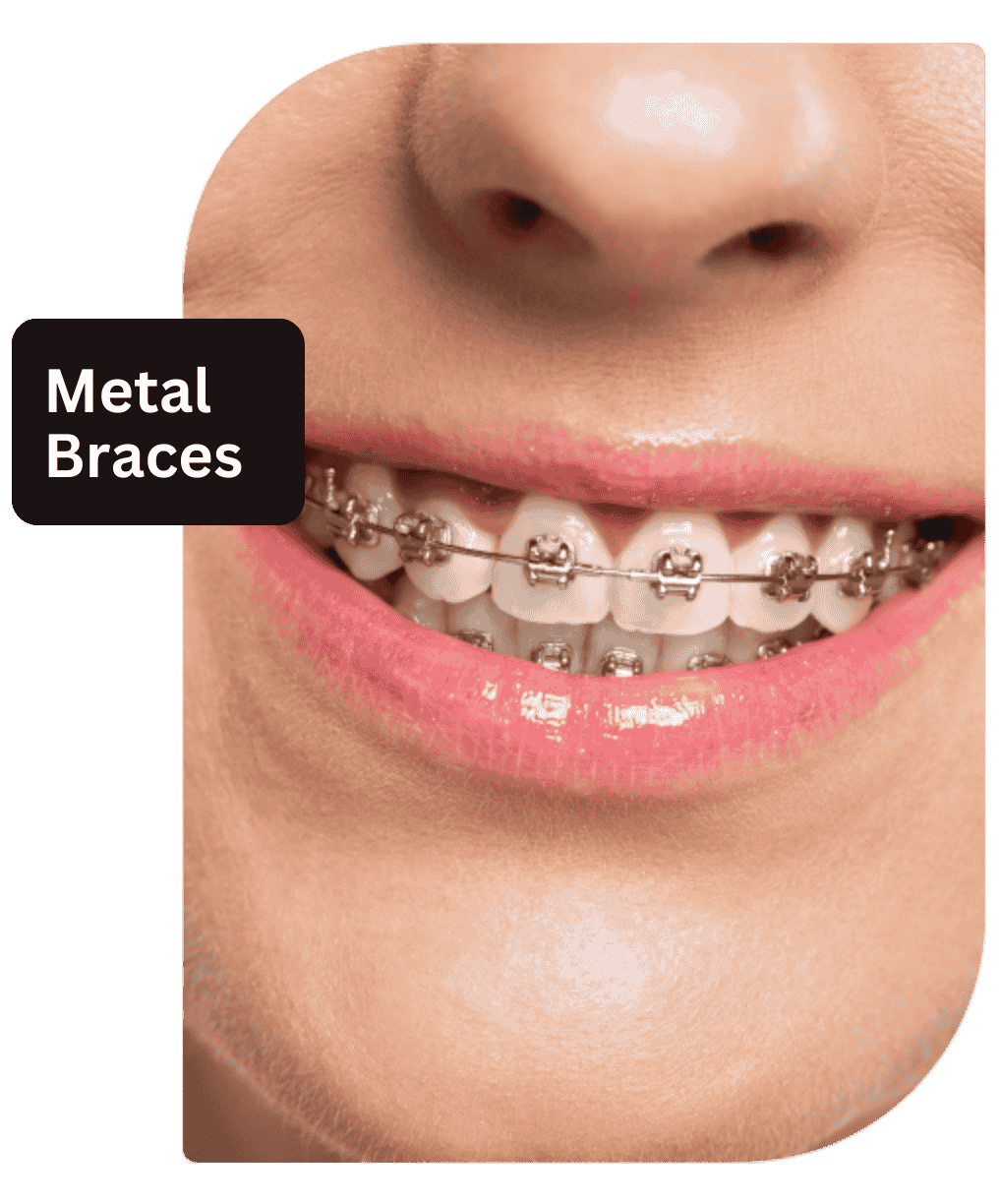 metal_braces_smile