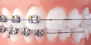 Why Choose Ceramic Braces - Invisible Braces Why Choose Ceramic Braces