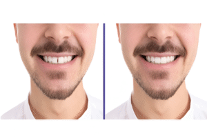 Gapped Teeth