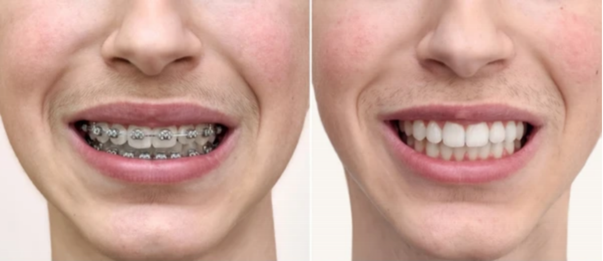 Metal Braces in Khar, Mumbai