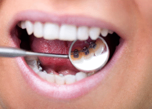 Types of Lingual Braces