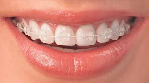 Benefits of Damon Clear Braces - Invisible Braces Benefits of Damon Clear Braces