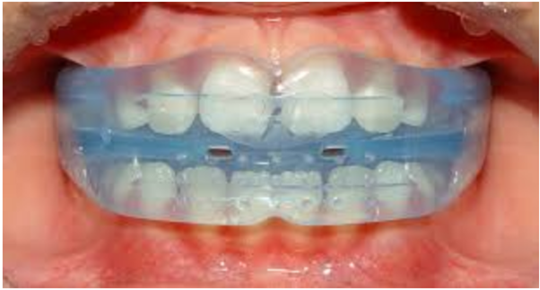 s2 - Invisible Braces