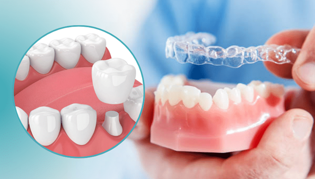 Aligners with Crowns and Bridges