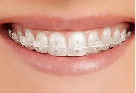 Invisible Braces
