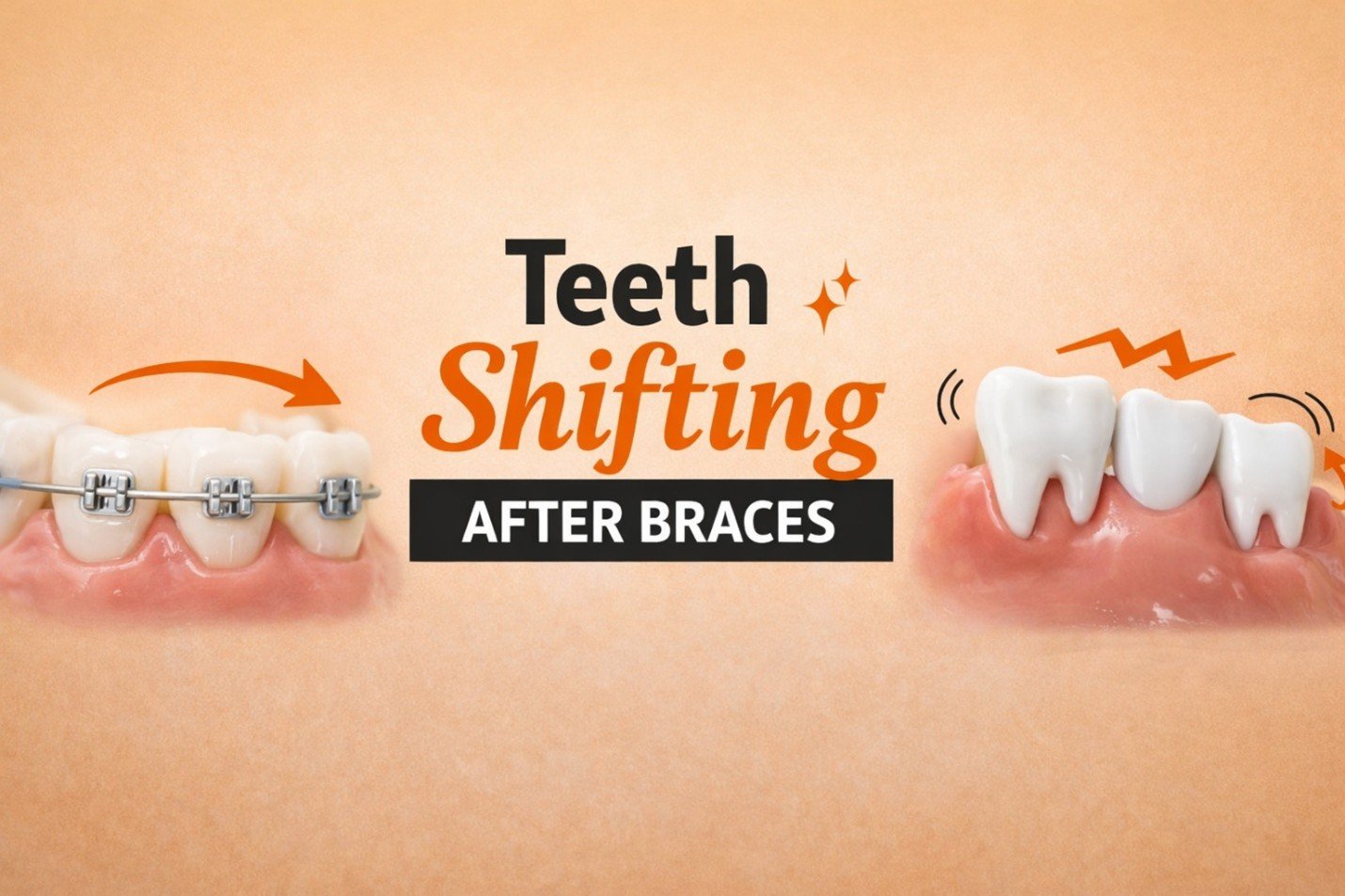 Teeth Shifting After Braces