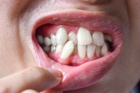 Picture2 - Invisible Braces