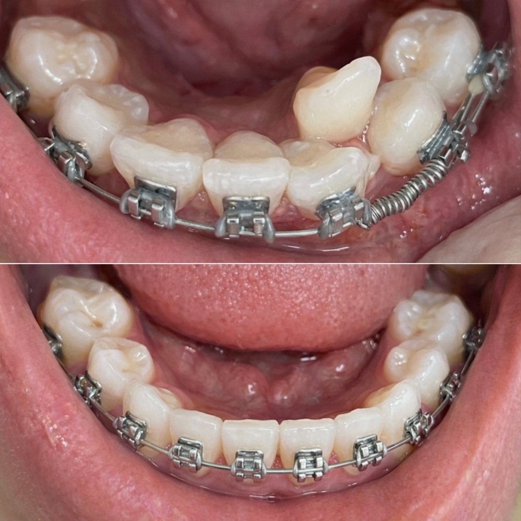 Picture2 - Invisible Braces
