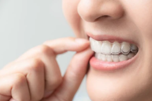 Picture3 - Invisible Braces