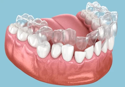 Picture3 - Invisible Braces