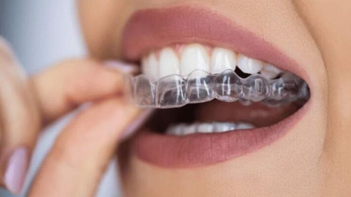 Why Do My Aligners Hurt More Than Usual?