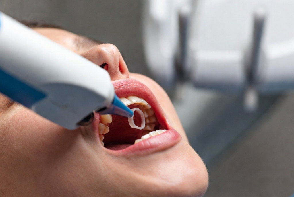 Close-up of a child's open mouth during dental treatment, with a blue dental tool near the upper teeth.