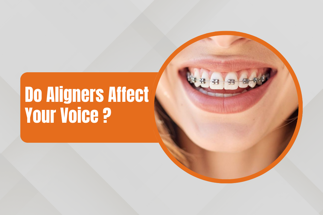 Do Aligners Affect Your Voice