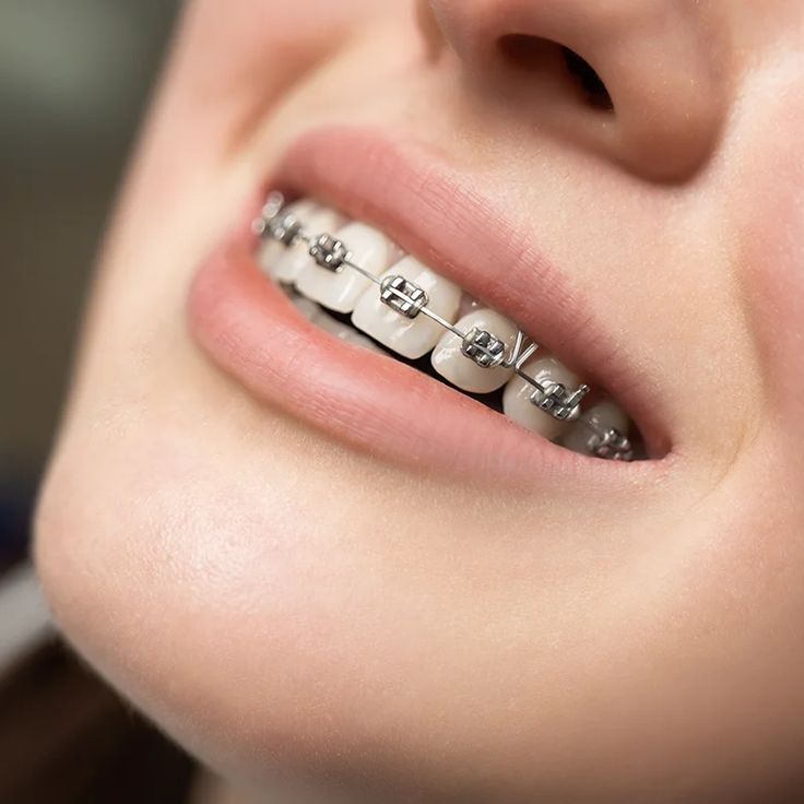 When Do You Need Jaw Surgery Instead of Just Braces?