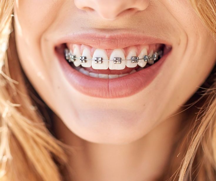 Do Aligners Affect Your Voice and Speech in 2026?