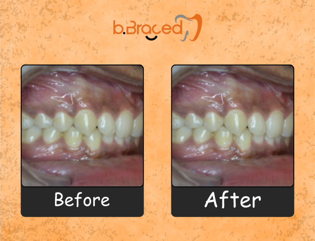 Teeth straightening before and after treatment