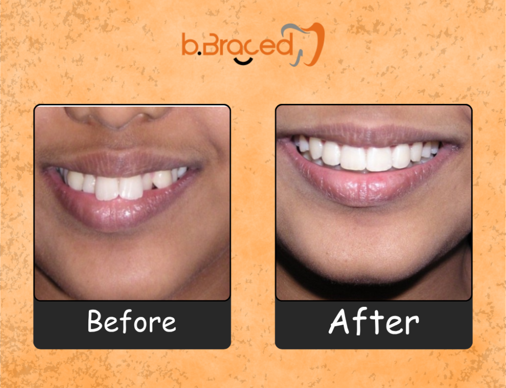 Smile correction before and after by Dr Pravin Shetty
