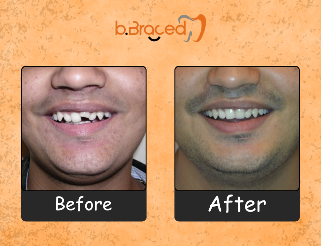 Teeth straightening before and after treatment