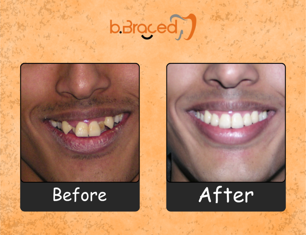 Before and after braces treatment for crowded teeth