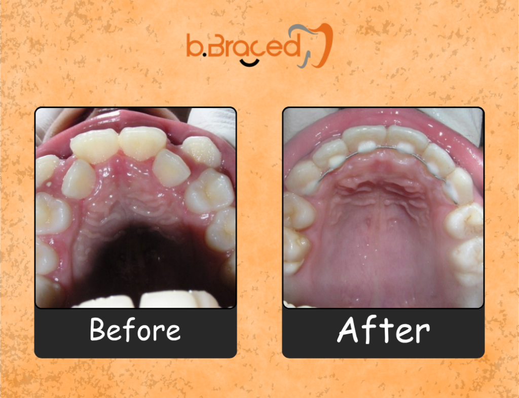 Before: crowded, misaligned upper teeth in an open-mouth view. After: straighter upper teeth with a palatal appliance visible following braces treatment.