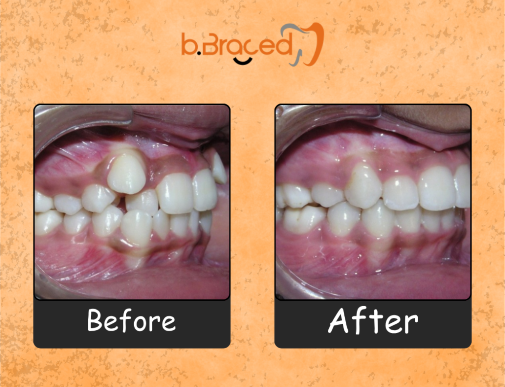 Orthodontic treatment results at B.Braced Mumbai