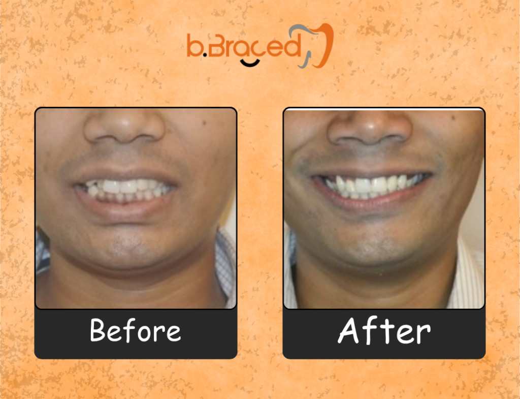 Digital orthodontic smile transformation