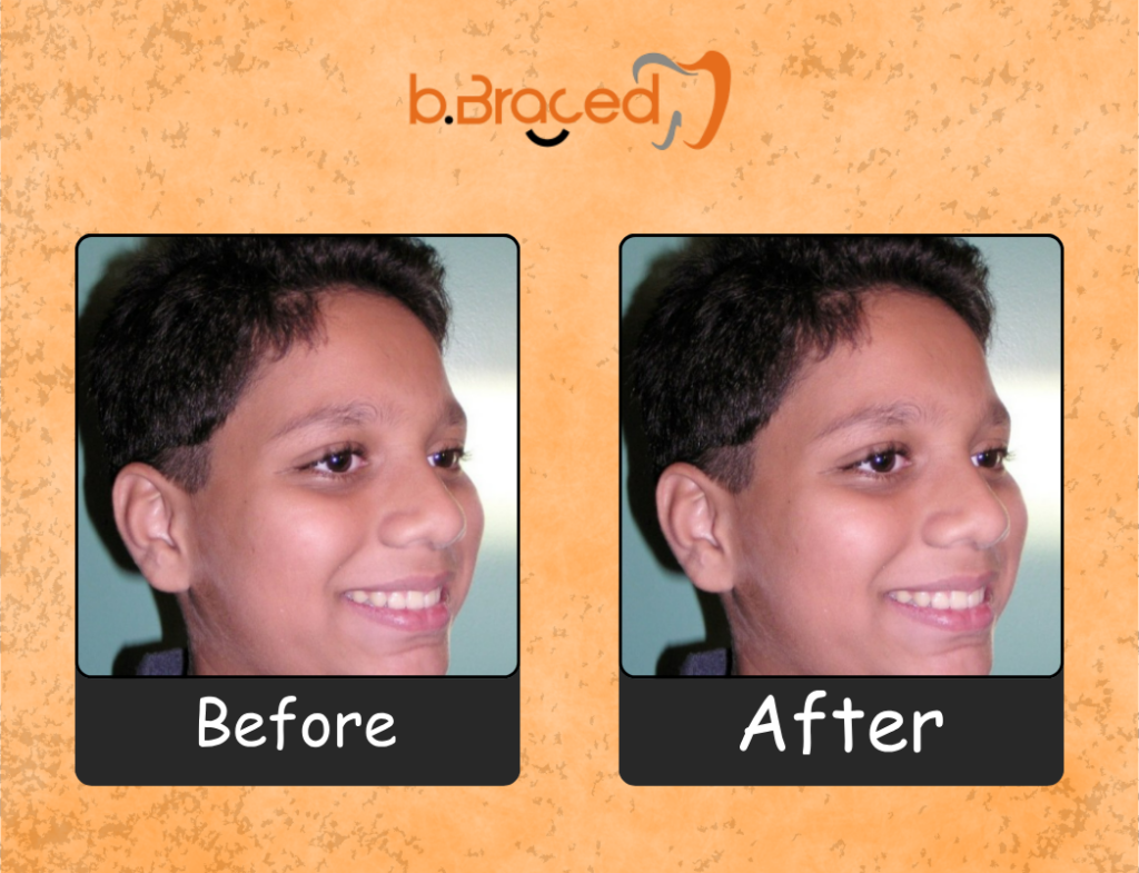 Digital orthodontic smile transformation