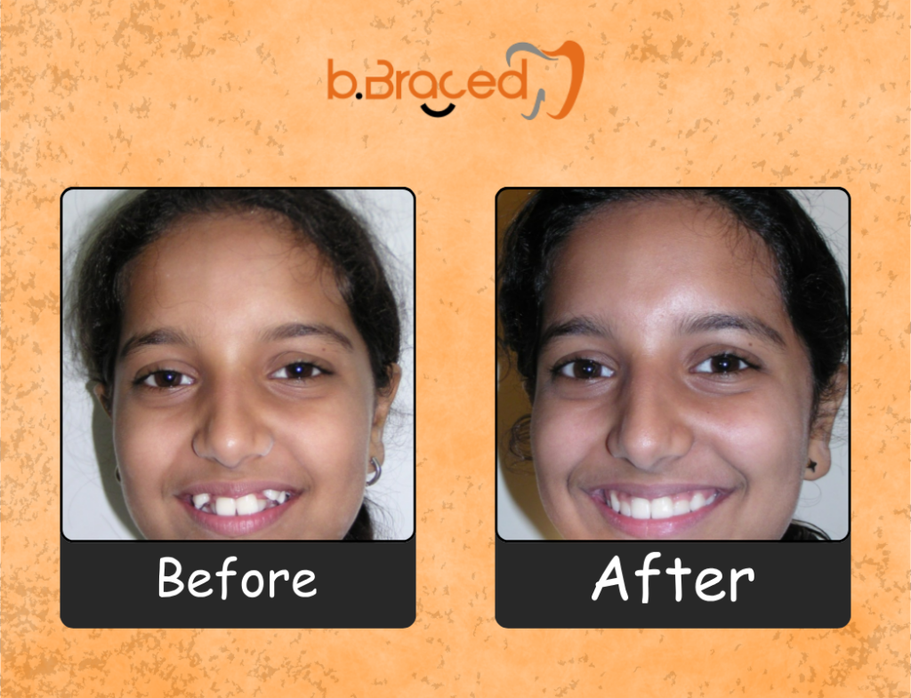 Teeth straightening before and after treatment
