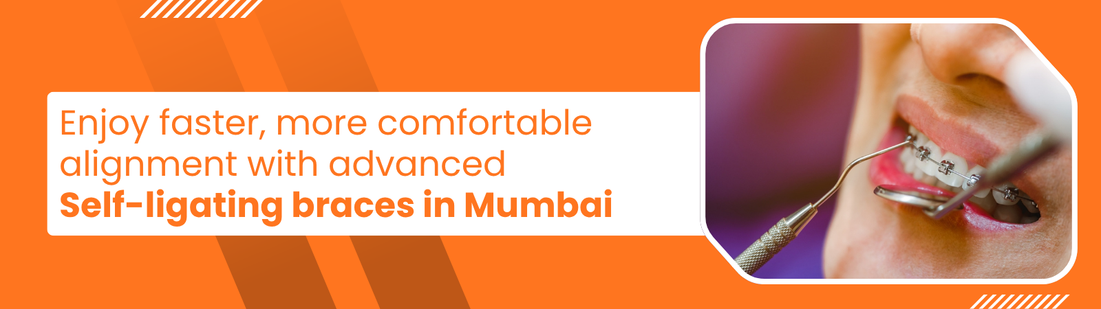 Enjoy faster more comfortable alignment with advanced Self-ligating braces in Mumbai - Invisible Braces - Invisible Braces Banner ad promoting self-ligating braces in Mumbai; close-up of braces being adjusted on a patient