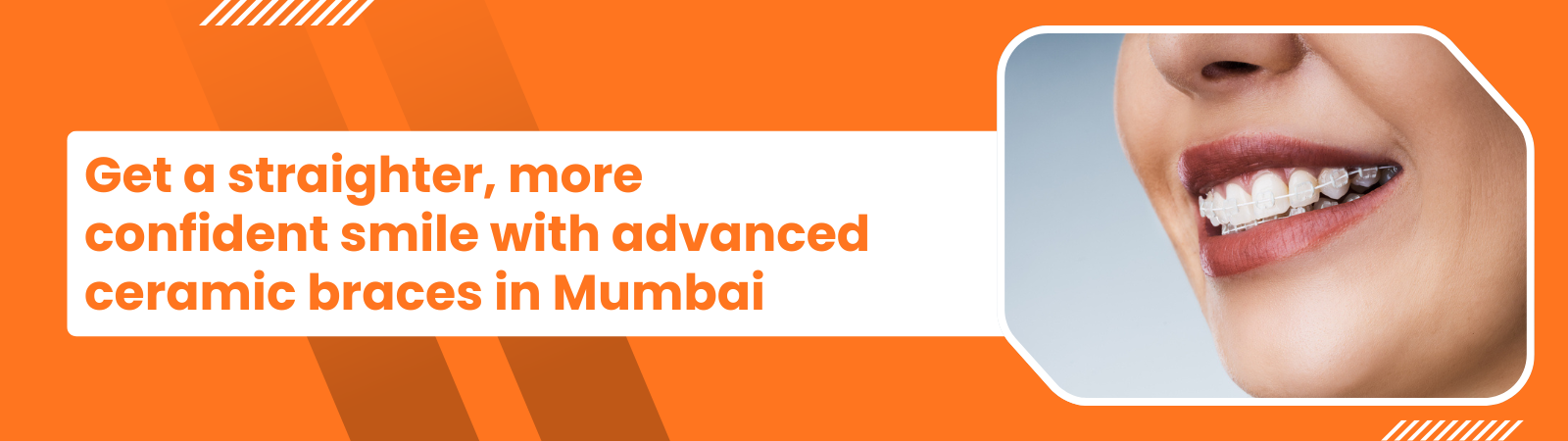 Advertisement banner promoting ceramic braces in Mumbai with a smiling person wearing braces on the right side.