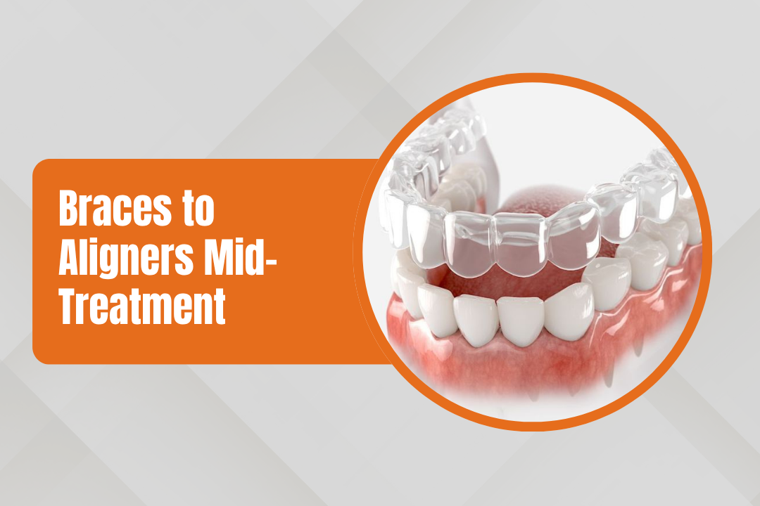 Can You Switch from Braces to Aligners Mid-Treatment?