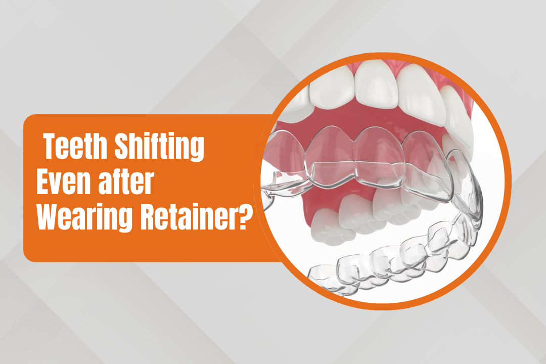 Why Are My Teeth Shifting Even Though I Wear My Retainer?