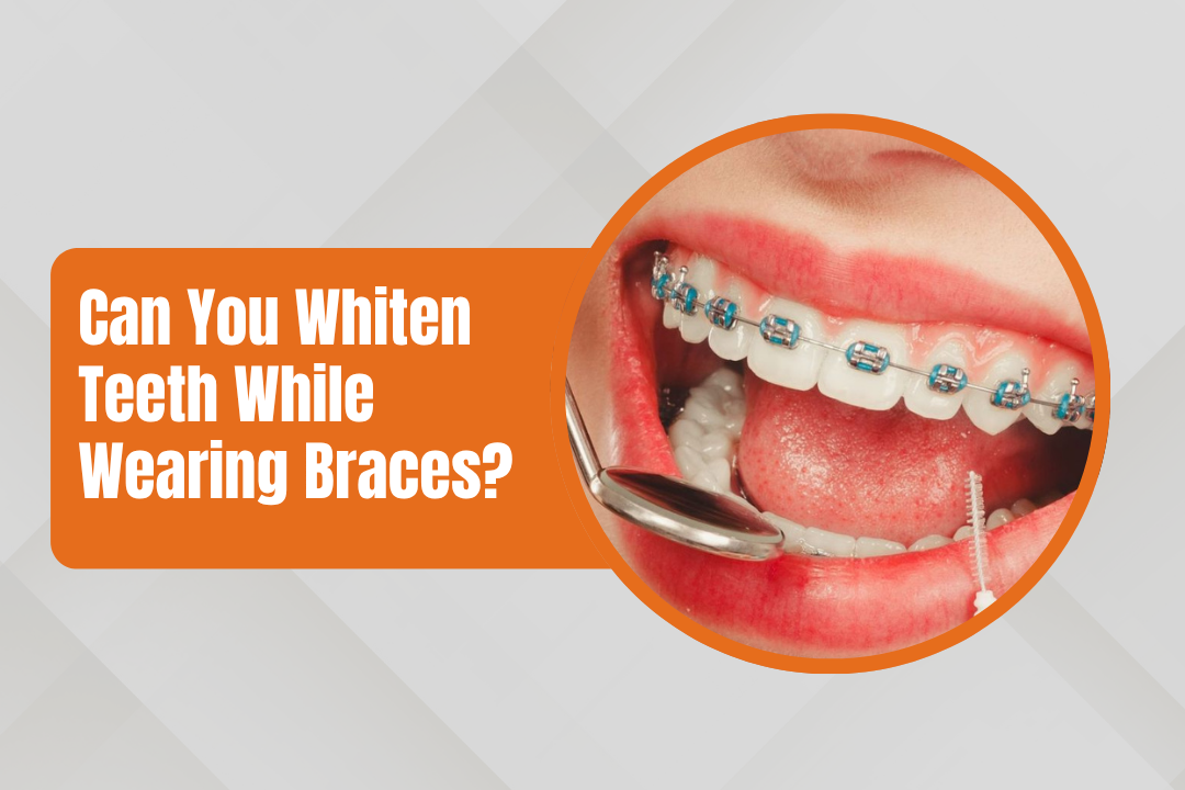 https://invisiblebraces.in/why-do-my-aligners-smell-bad-even-after-cleaning/