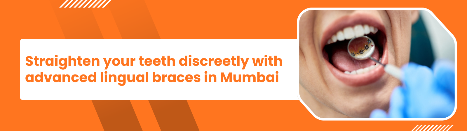 Promotional banner for discreet lingual braces in Mumbai, featuring a close‑up of a mouth showing inner‑surface braces.